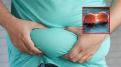 Alertan por relación entre obesidad, diabetes y algunos tipos de cáncer